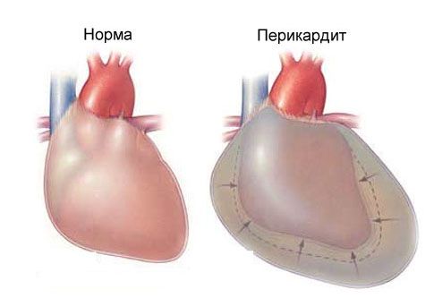 급성 심낭염과 흉통