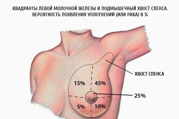 왼쪽 가슴의 사분면과 겨드랑이의 겨드랑이.  물개 (또는 암)의 가능성 (%)
