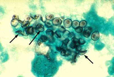 Pneumocystis (Pneumocystis jiroveci)의 원인균