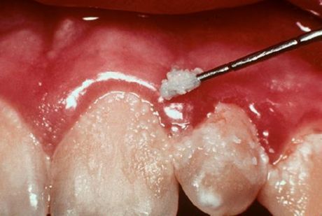 치아 및 치염