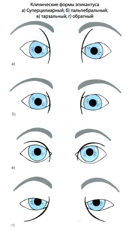 Epicanthus의 임상 형태.  a) Superciliary, b) palpebral, c) tarsal, d) reverse